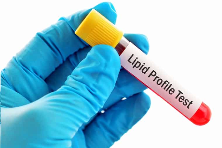 Lipid profile test at microsidd diagnostics